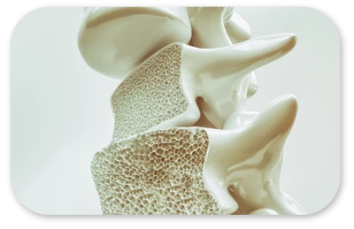 Osteoporose